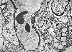 M,28y. | hemangioblastoma - brain M,28y. | hemangioblastoma - brain